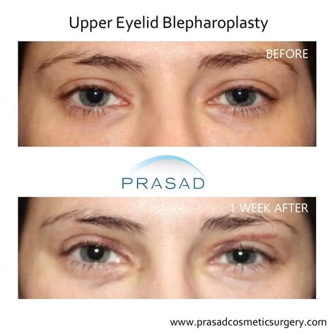 Upper Blepharoplasty Before and After Photos | Gallery