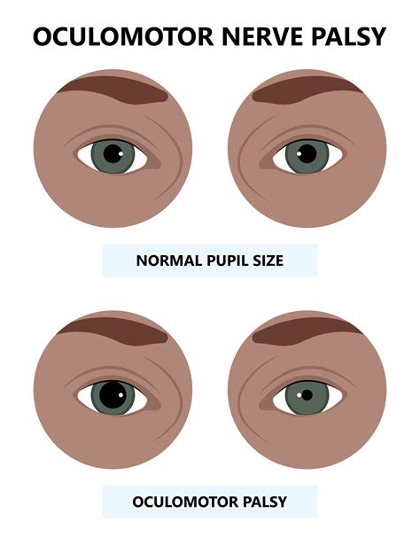 Oculomotor Nucleus Brain
