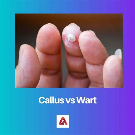 Corn Callus Vs Wart at Duane Stokes blog