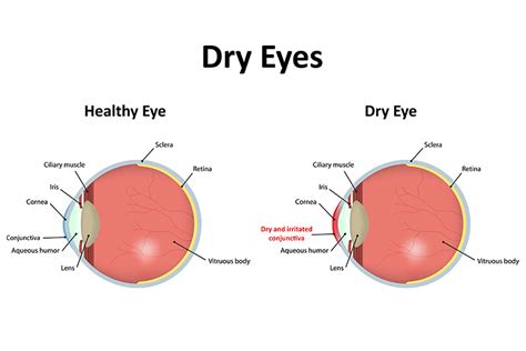 Image result for Common Eye Problems