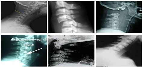 Classification of Cervical Spine Fracture and Dislocation Using Refined ...