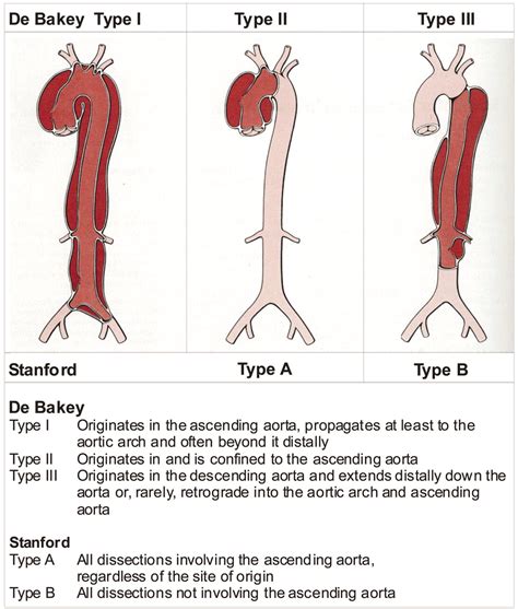 Aortic Dissection - Stepwards