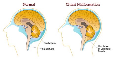 Type I Chiari Malformation