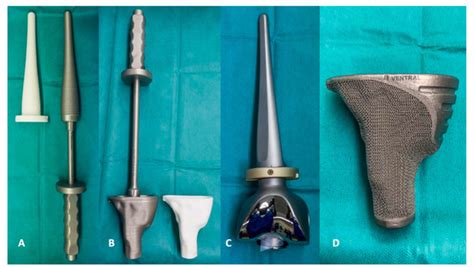 JPM | Special Issue : Patient-Specific Implants in Musculoskeletal ...