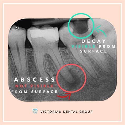 Abscess Tooth Xray