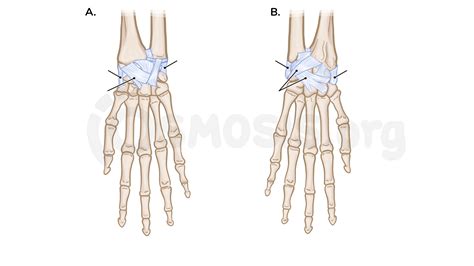 Joints of the wrist and hand | Osmosis
