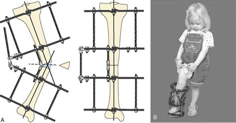 Orthopedic Surgery Anesthesia Management 的图像结果