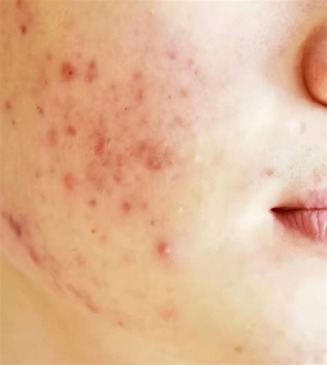 Inurskn - Acne Scars & Pimples Treatment Clinic in Mumbai