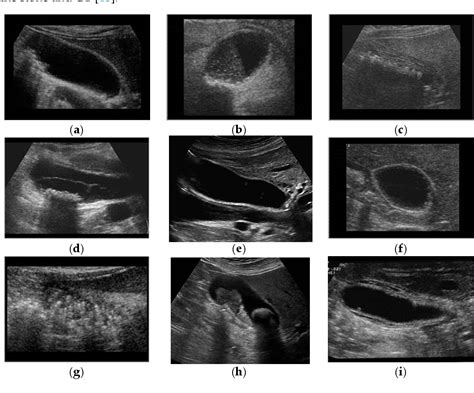 Image result for Gallbladder Test