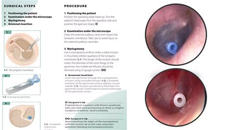 Serous Otitis media and Grommets | PPTX