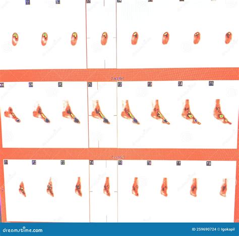 Three Phase Bone Scan Active Inflammation Spect Stock Photo - Image of ...