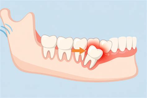 Swollen Gums Around Wisdom Teeth: Is This Normal or a Problem?