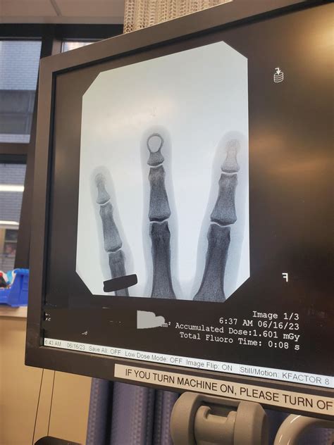 There is a cyst inside the bone of my middle finger : r/mildlyintresting