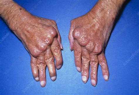 Hands with rheumatoid arthritis - Stock Image - M110/0034 - Science ...