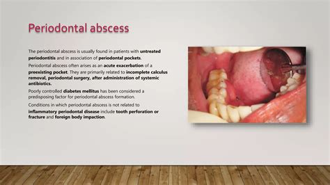 Abscess of periodontium | PPTX
