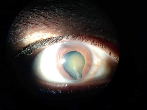 Desprendimiento de retina asociado a coloboma coriorretiniano – Oftalmólogo al Día