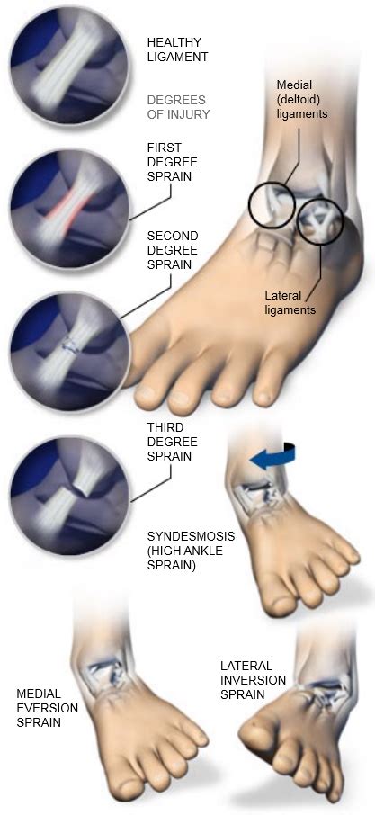 Ankle Sprains | Central Coast Orthopedic Medical Group