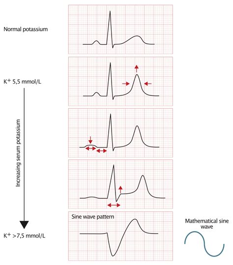 ECG changes due to electrolyte imbalance (disorder) – The Cardiovascular