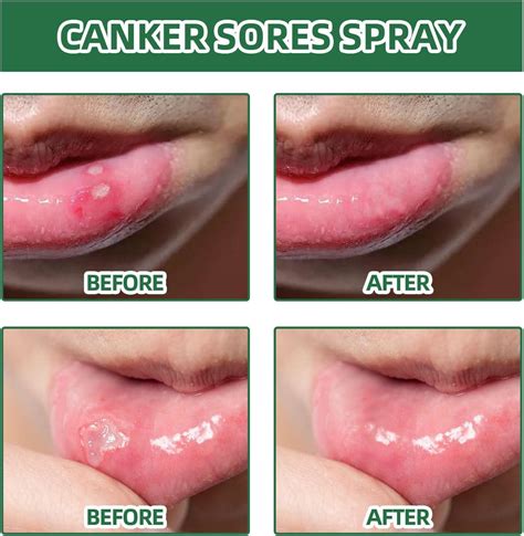 Oral Ulcer Relief Spray 20ml - Canker Sore & Gum Pain Relief Treatment ...