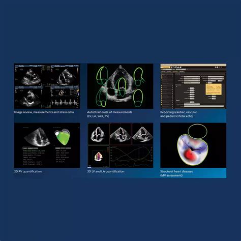 Ultrasound Workspace | Philips