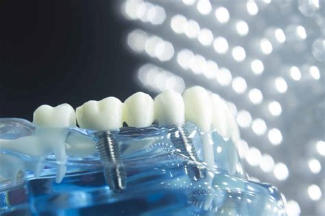 Are Dental Implants Safe? Here’s What You Need to Know