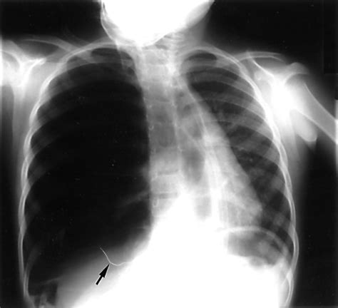 Open Pneumothorax X Ray Pneumothorax Physiopedia