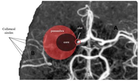 The Pathophysiology of Collateral Circulation in Acute Ischemic Stroke