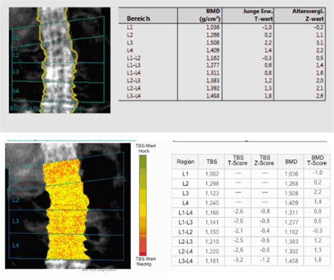 Is the Trabecular Bone Score (TBS) a Useful Tool in Patients with Diffuse Idiopathic Skeletal ...