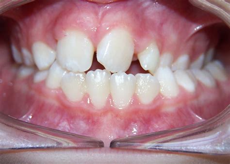 Image result for Crossbite Treatment Options
