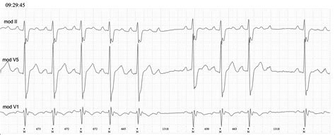 Second degree AVB Mobitz Type II | ECG Guru - Instructor Resources
