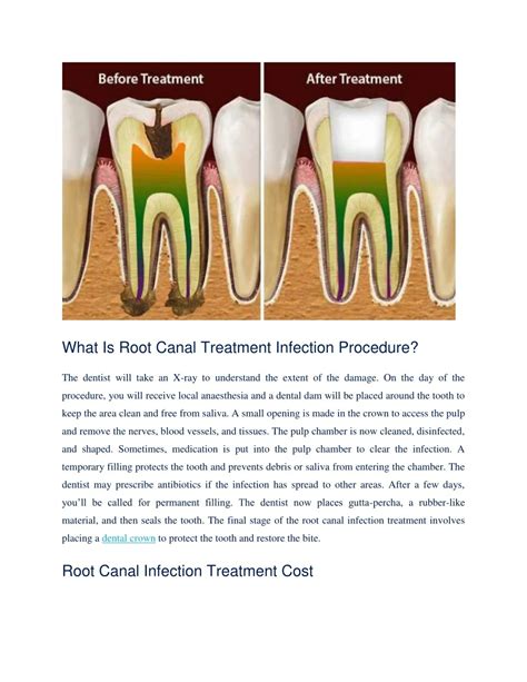 Root Canal Procedure With Infection at Elaine Boehme blog
