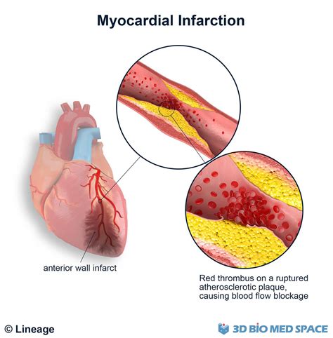 Pathophysiology and Clinical Presentation – Correct Diagnosis ...