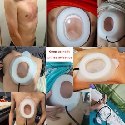 Exemic Pectus Vacuum Bell,Funnel Chest India | Ubuy