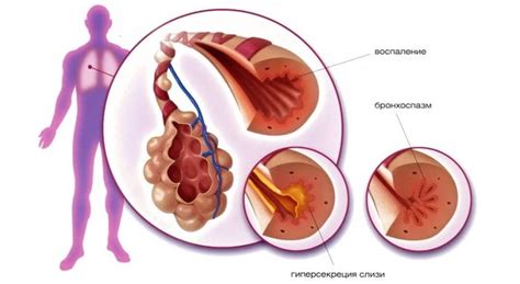 Бронхиальная астма: классификация, виды и формы у детей и взрослых