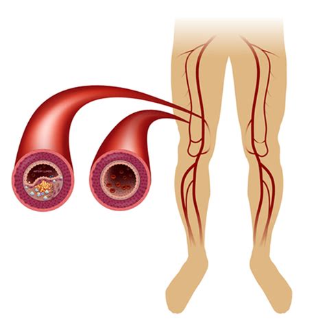 Can bypass be done along with Peripheral Artery Intervention? | FAQ ...