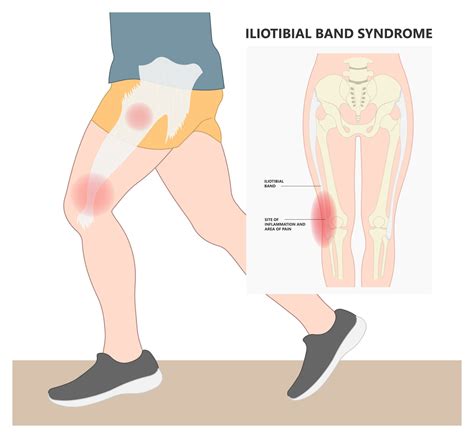 Iliotibial Band Syndrome - What Causes It, How To Treat And Prevent - Gulf Physio