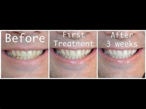 Baking Soda Peroxide Toothpaste Whitening Recipe | Besto Blog