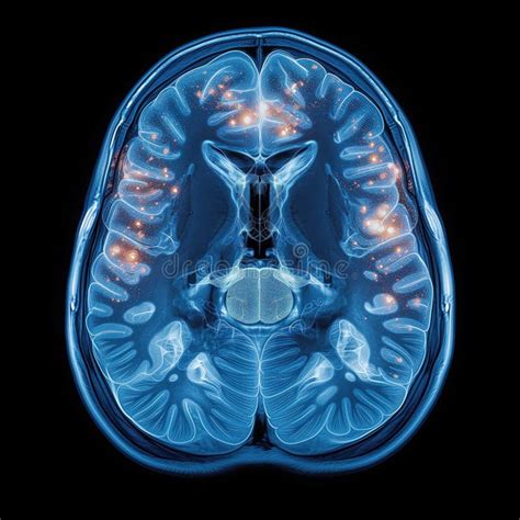 Brain CT Scan 的图像结果