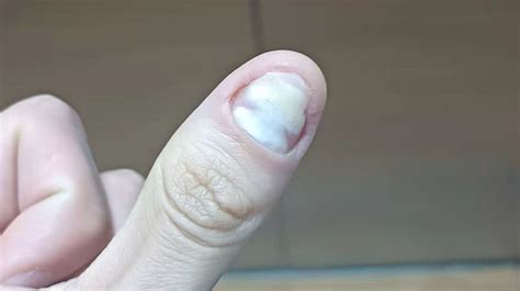 自己治疗灰指甲的常用涂抹药哪种较好？我的三个月恢复日记 - 知乎