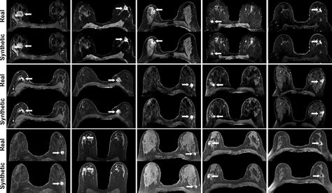 Deep Learning to Simulate Contrast-enhanced Breast MRI of Invasive Breast Cancer | Radiology
