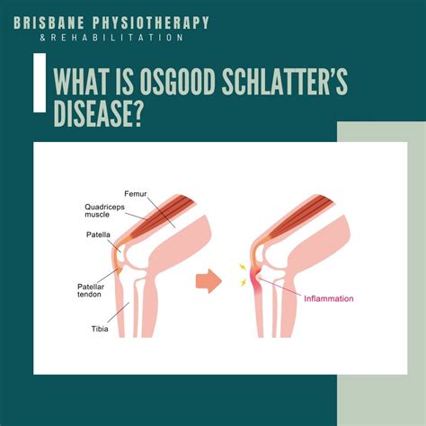Osgood Schlatter Disease Diagram Sinew Therapeutics :: Osgood