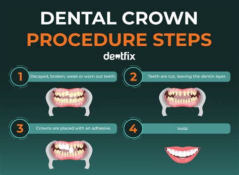 Dental Crown Procedure: Prep, Sessions, and Final Result - Dentfix