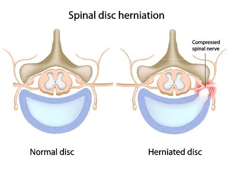 Advanced Spine: Disc Herniation Relief Westchester - Herniated Disc Exercises