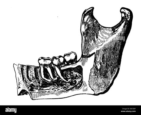Image result for Medieval Tooth Extraction