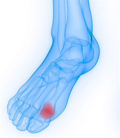 Hallux Rigidus Anatomy