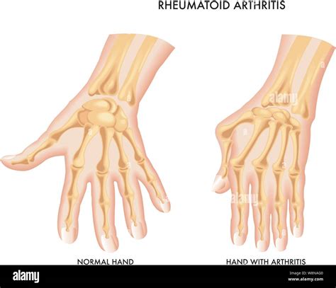Rheumatoid arthritis hands hi-res stock photography and images - Alamy