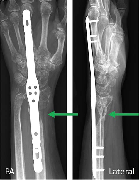 Image result for Open Reduction Distal Radius Fracture