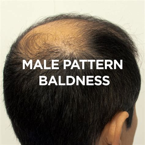 Male Pattern Baldness – Soulflower.in