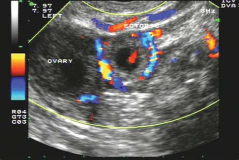 Ectopic Pregnancy Ultrasound 7 Weeks