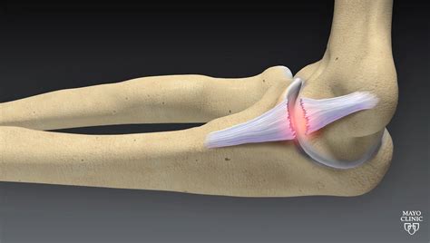 Ulnar Collateral Ligament Elbow Tear